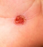 Ace-Clinic---Verruca--warts-image-01