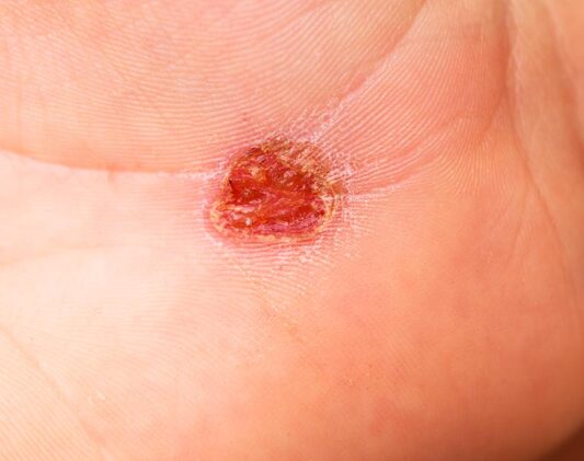 Ace-Clinic---Verruca--warts-image-01