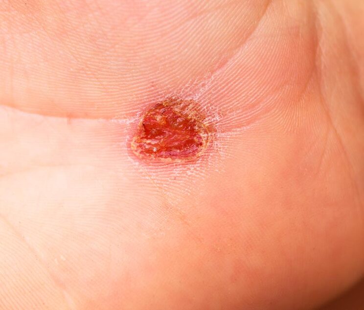 Ace-Clinic---Verruca--warts-image-01