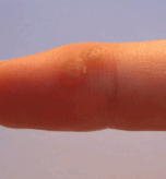 wart