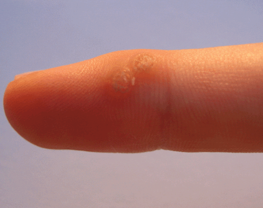 wart