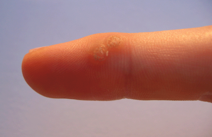 wart