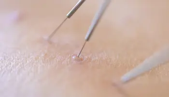 Ace-Clinic-Verruca Needling-Featured-image-01