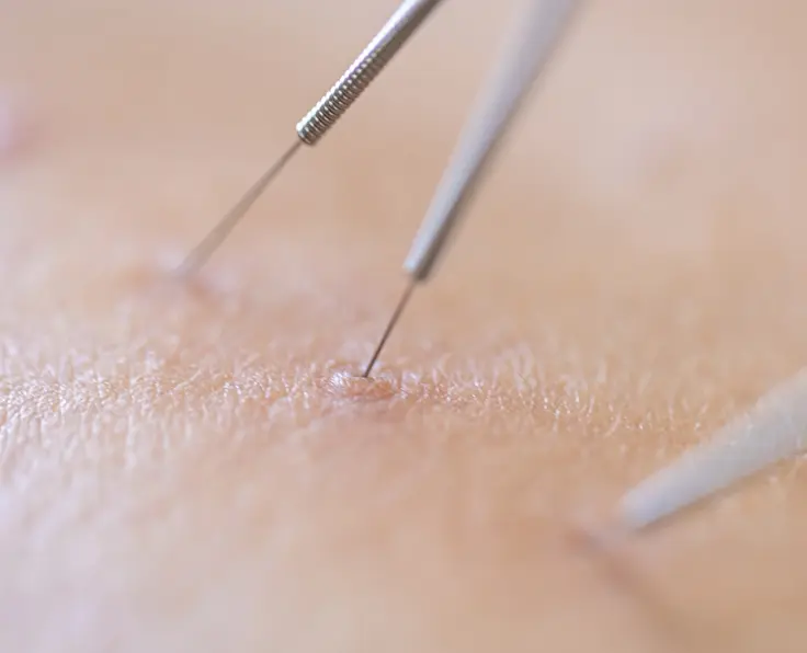 Ace-Clinic-Verruca Needling-Featured-image-01
